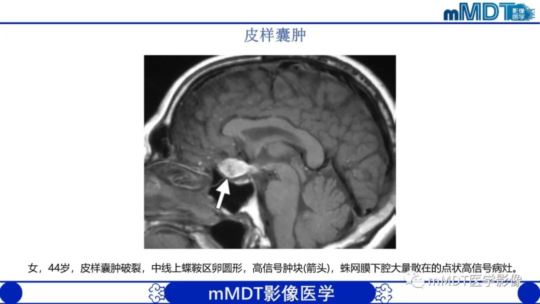 影像PPT - 【PPT】颅内呈短T1信号病变的概述及鉴别诊断-25