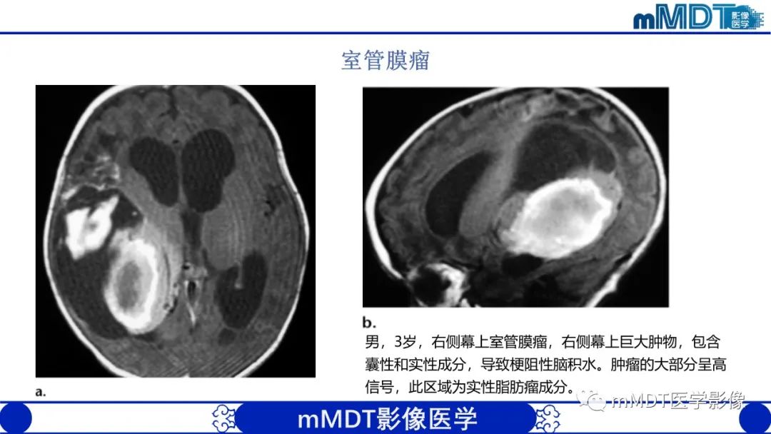 影像PPT - 【PPT】颅内呈短T1信号病变的概述及鉴别诊断-26