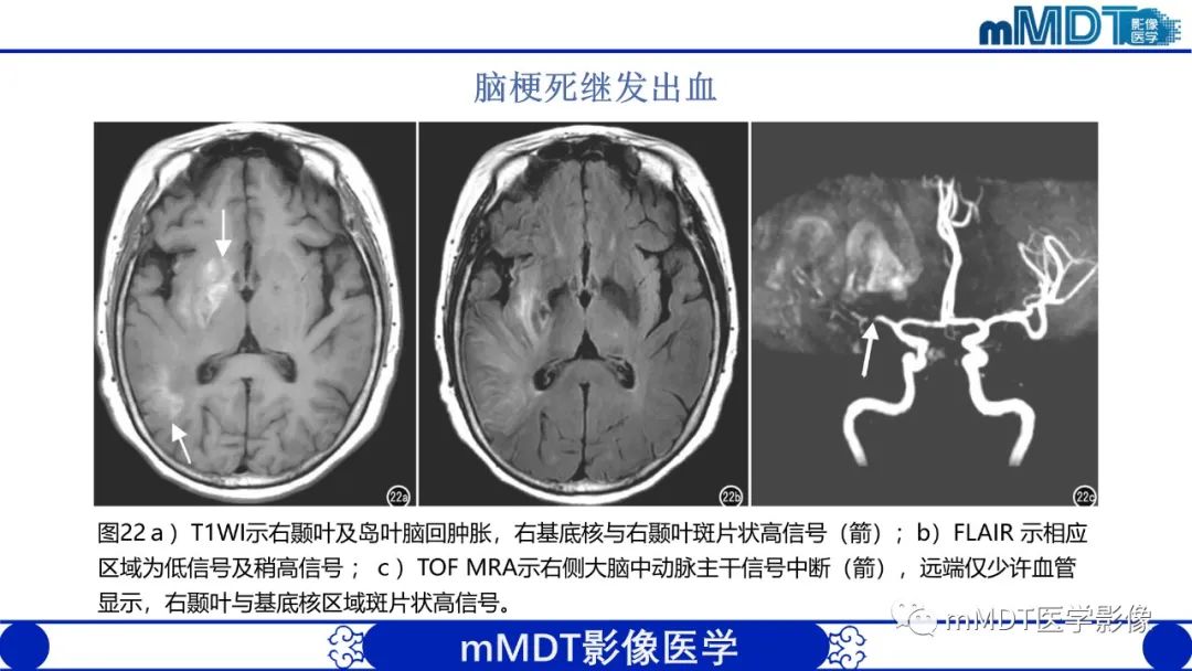 影像PPT - 【PPT】颅内呈短T1信号病变的概述及鉴别诊断-28