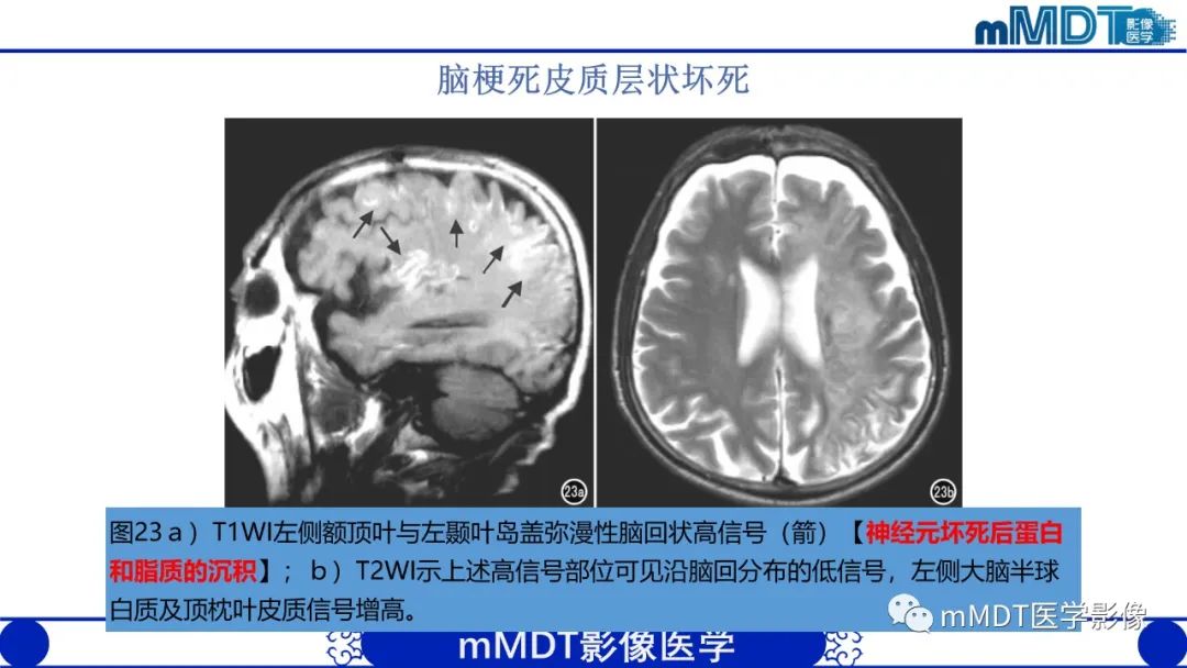 影像PPT - 【PPT】颅内呈短T1信号病变的概述及鉴别诊断-29