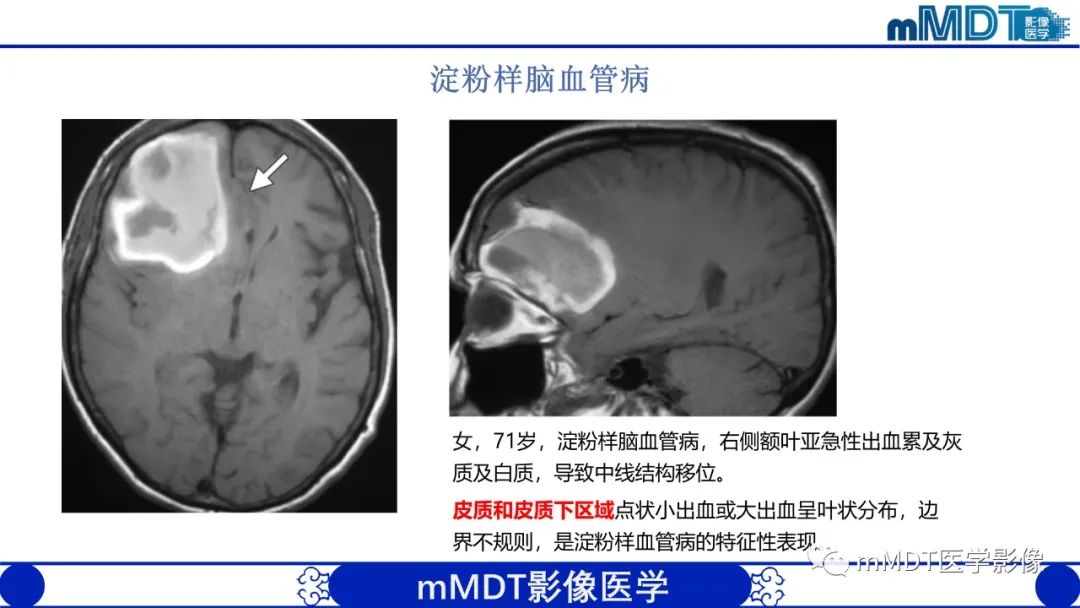 影像PPT - 【PPT】颅内呈短T1信号病变的概述及鉴别诊断-30