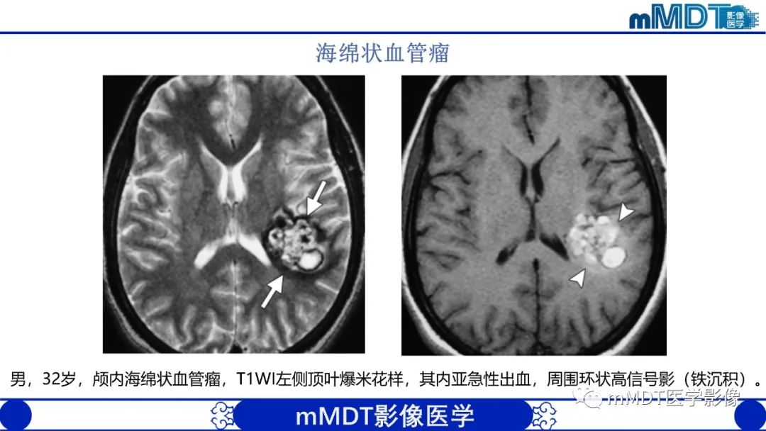 影像PPT - 【PPT】颅内呈短T1信号病变的概述及鉴别诊断-31
