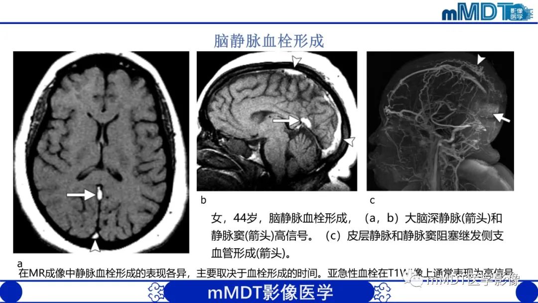影像PPT - 【PPT】颅内呈短T1信号病变的概述及鉴别诊断-32