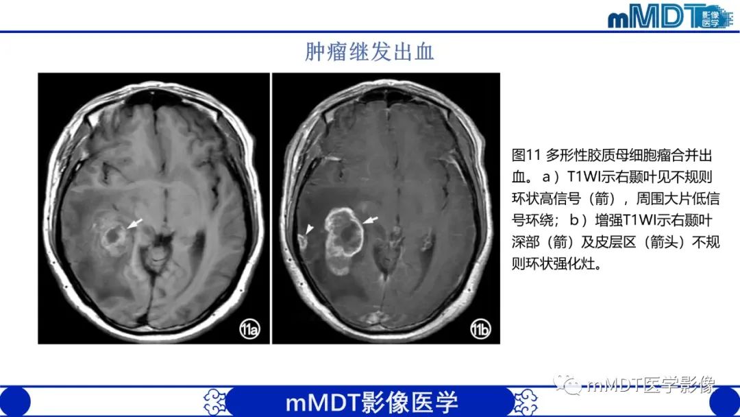 影像PPT - 【PPT】颅内呈短T1信号病变的概述及鉴别诊断-33