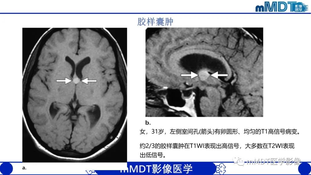 影像PPT - 【PPT】颅内呈短T1信号病变的概述及鉴别诊断-35