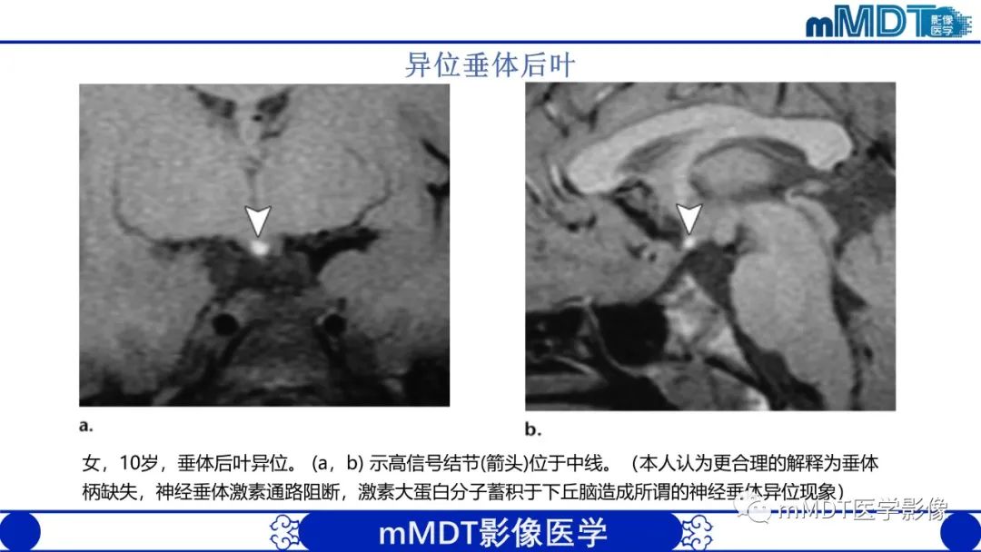 影像PPT - 【PPT】颅内呈短T1信号病变的概述及鉴别诊断-37