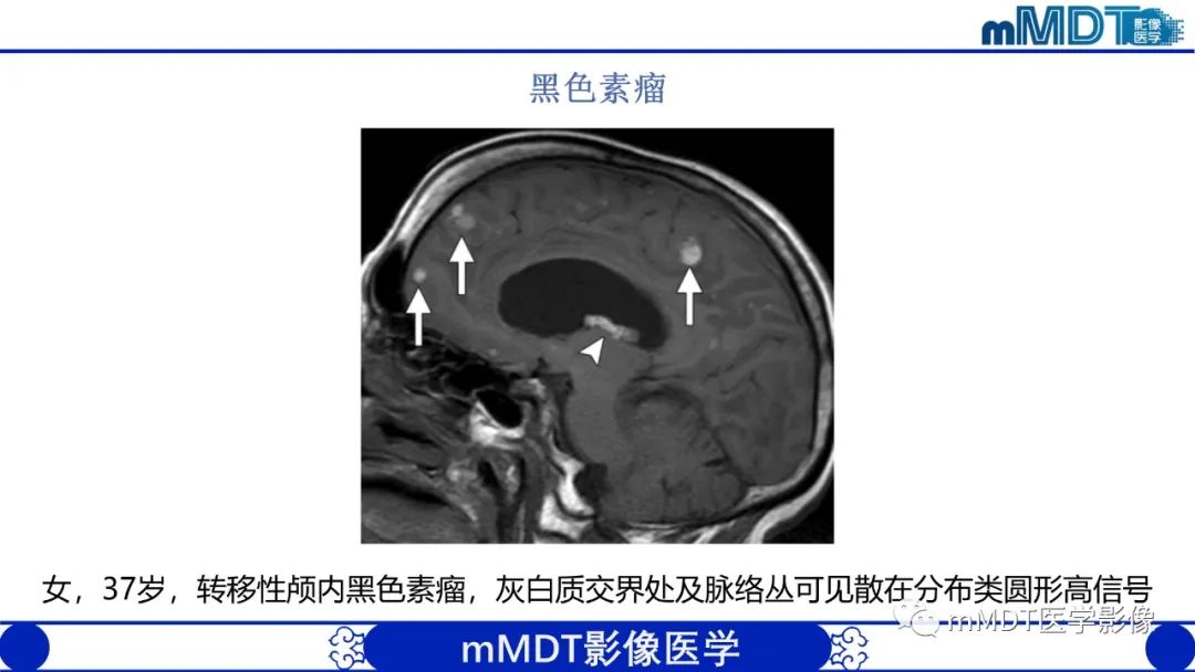 影像PPT - 【PPT】颅内呈短T1信号病变的概述及鉴别诊断-39