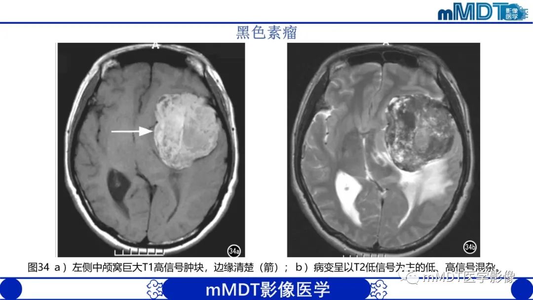 影像PPT - 【PPT】颅内呈短T1信号病变的概述及鉴别诊断-40