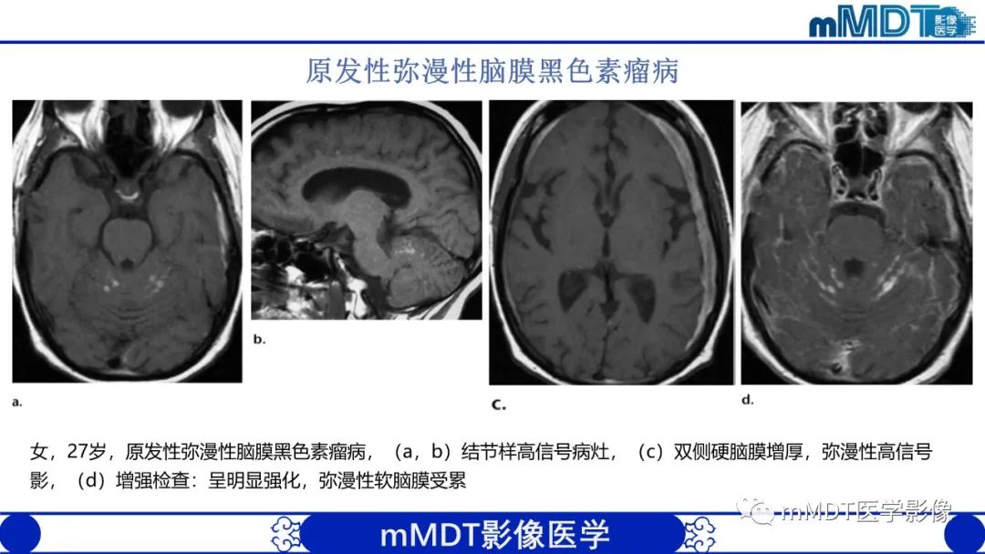 影像PPT - 【PPT】颅内呈短T1信号病变的概述及鉴别诊断-41