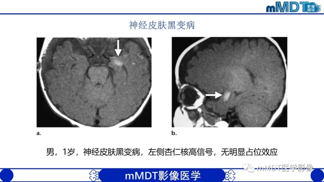 影像PPT - 【PPT】颅内呈短T1信号病变的概述及鉴别诊断-42