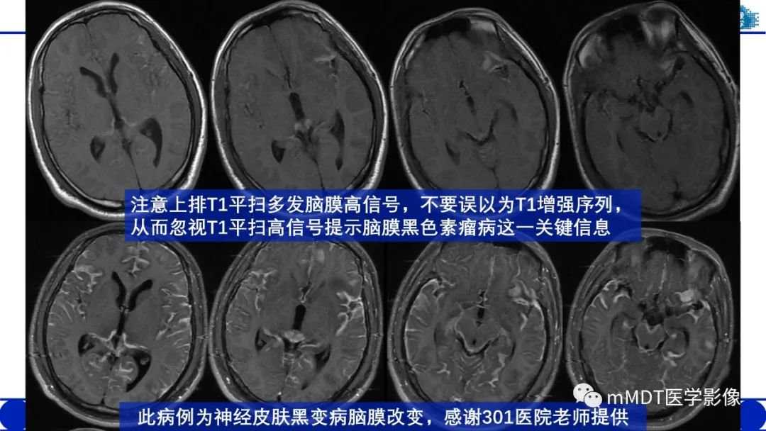 影像PPT - 【PPT】颅内呈短T1信号病变的概述及鉴别诊断-43