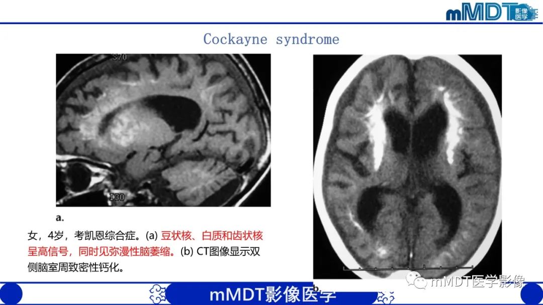 影像PPT - 【PPT】颅内呈短T1信号病变的概述及鉴别诊断-45