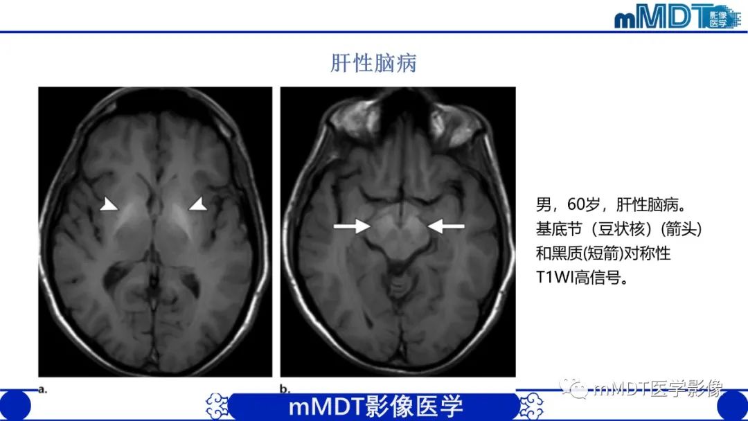 影像PPT - 【PPT】颅内呈短T1信号病变的概述及鉴别诊断-47