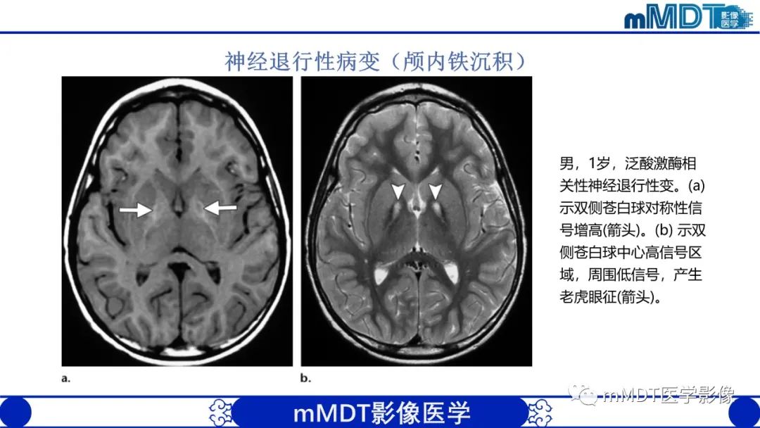 影像PPT - 【PPT】颅内呈短T1信号病变的概述及鉴别诊断-46