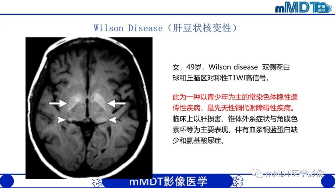 影像PPT - 【PPT】颅内呈短T1信号病变的概述及鉴别诊断-48