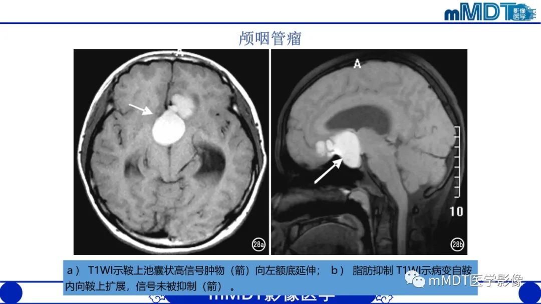影像PPT - 【PPT】颅内呈短T1信号病变的概述及鉴别诊断-54
