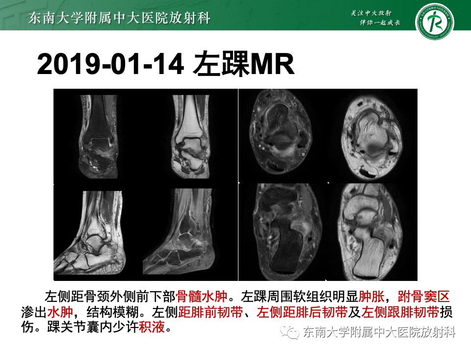 影像PPT - 【PPT】跗骨窦综合征-3