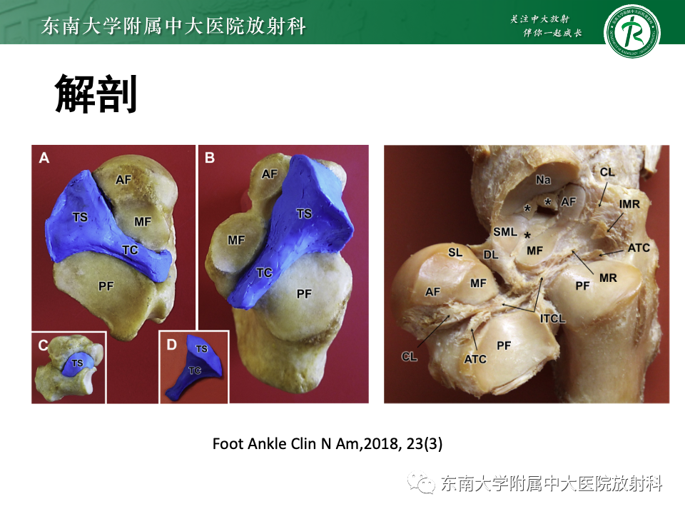 影像PPT - 【PPT】跗骨窦综合征-7