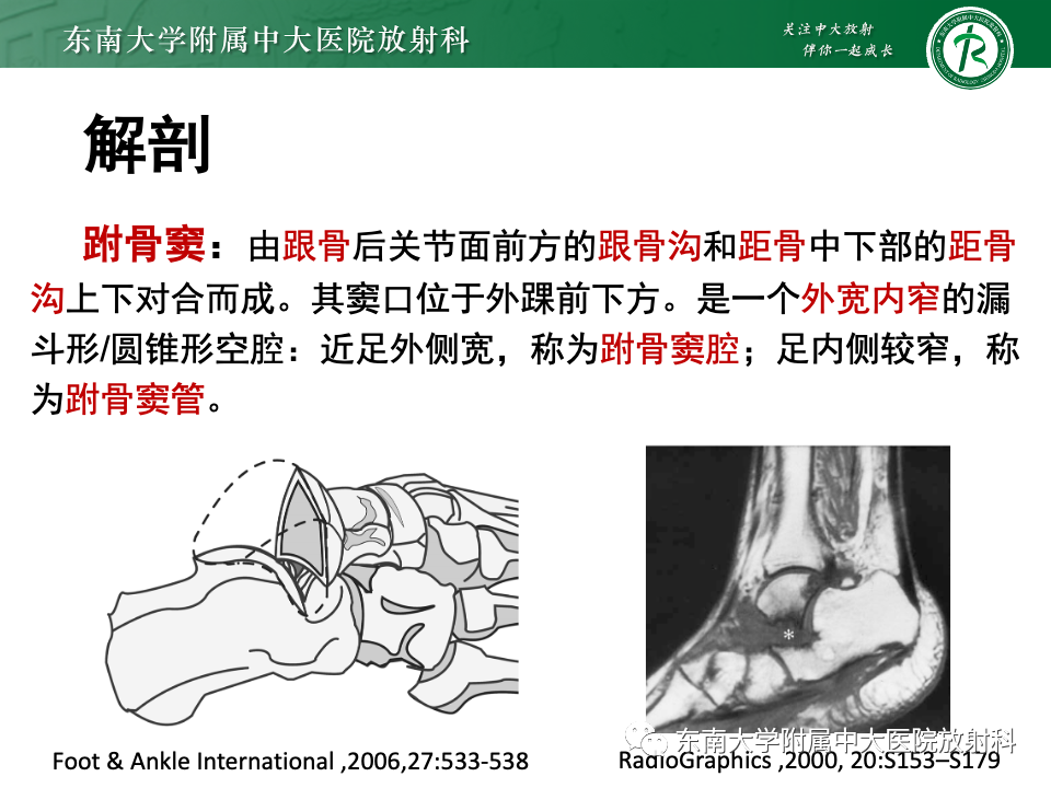 影像PPT - 【PPT】跗骨窦综合征-8