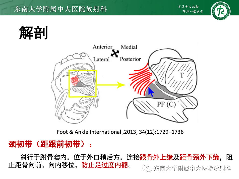 影像PPT - 【PPT】跗骨窦综合征-10