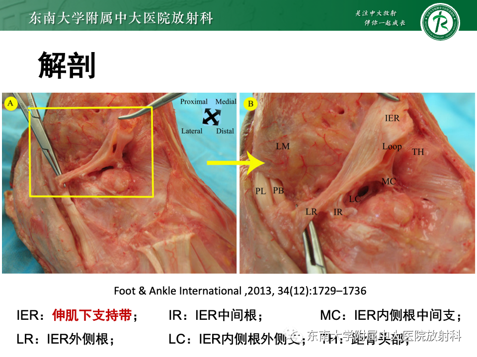 影像PPT - 【PPT】跗骨窦综合征-11