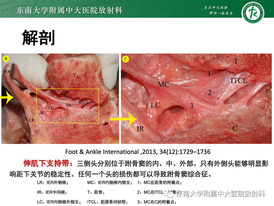 影像PPT - 【PPT】跗骨窦综合征-12