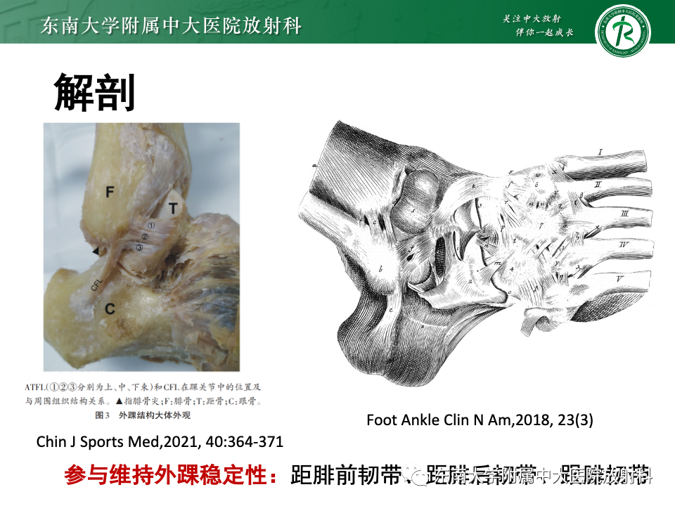 影像PPT - 【PPT】跗骨窦综合征-16