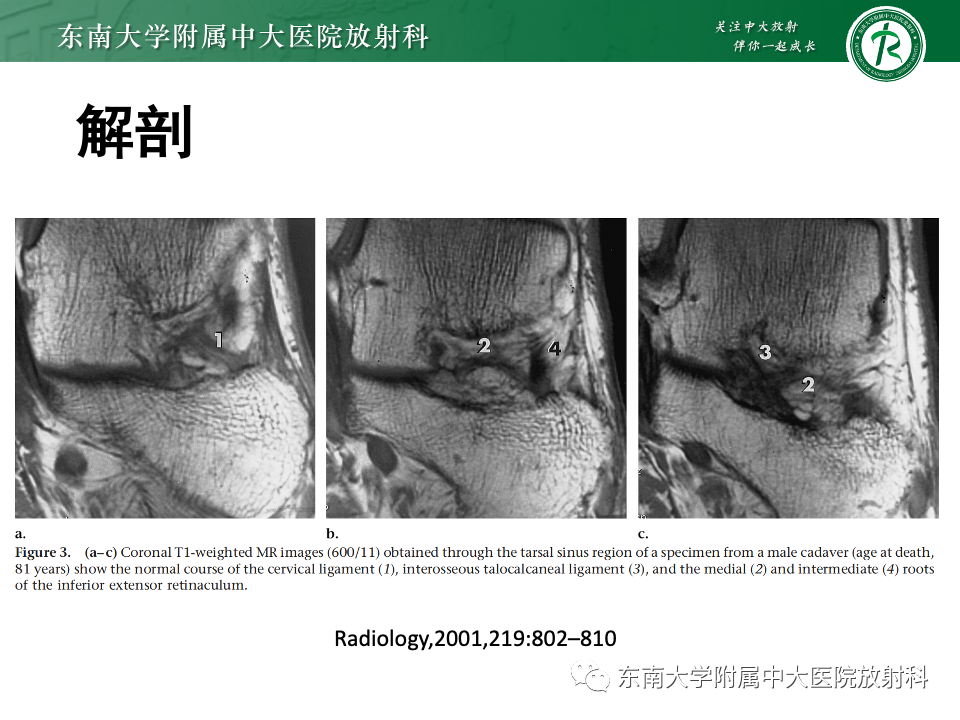 影像PPT - 【PPT】跗骨窦综合征-15