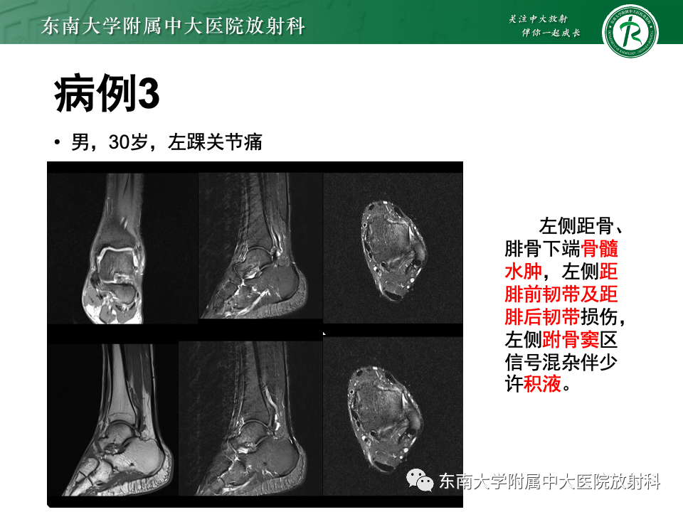 影像PPT - 【PPT】跗骨窦综合征-23