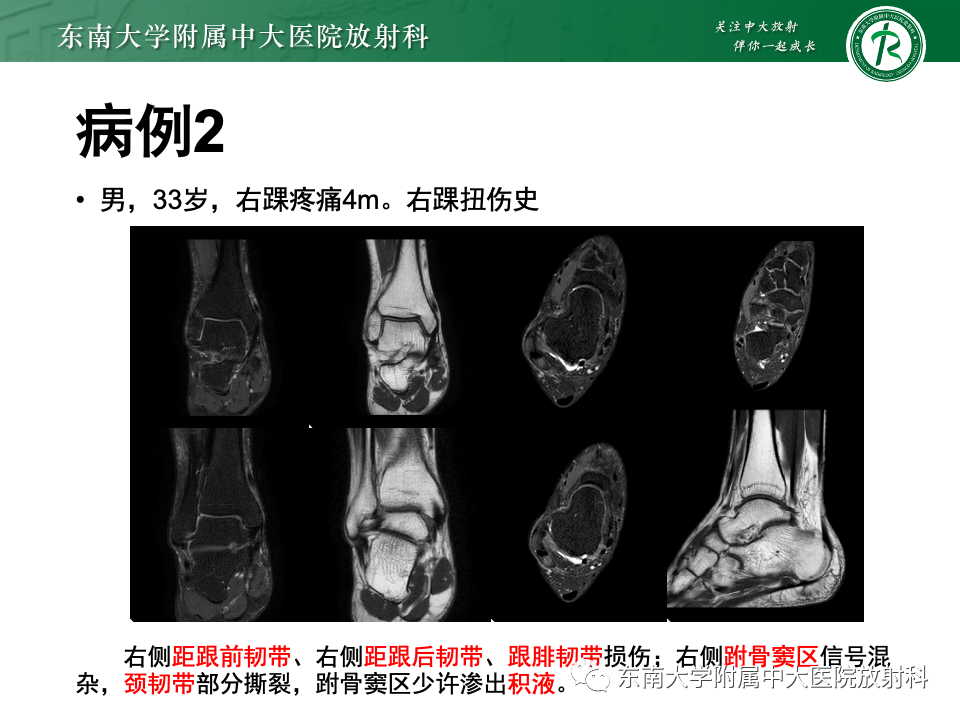影像PPT - 【PPT】跗骨窦综合征-22
