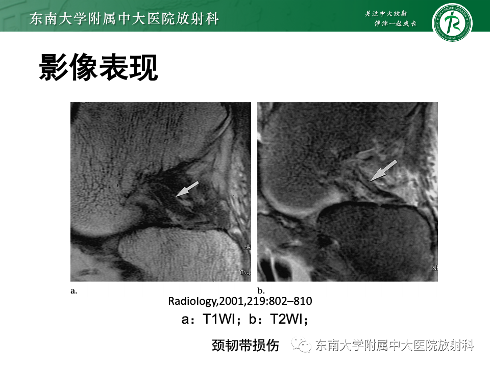 影像PPT - 【PPT】跗骨窦综合征-24