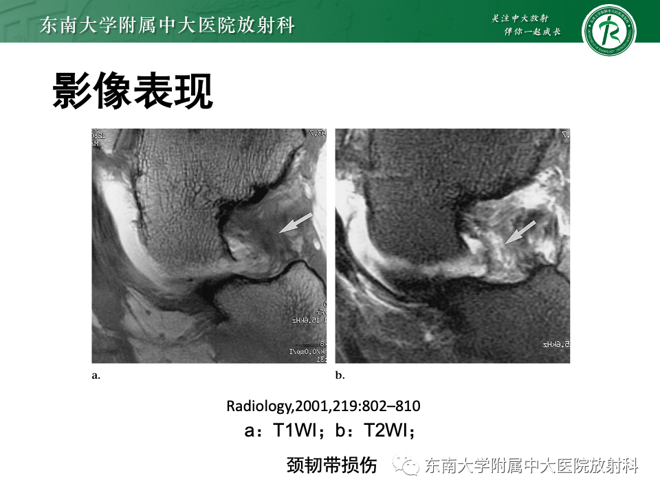 影像PPT - 【PPT】跗骨窦综合征-25