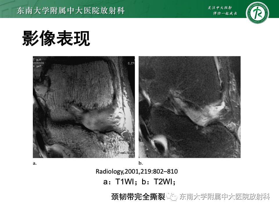 影像PPT - 【PPT】跗骨窦综合征-26