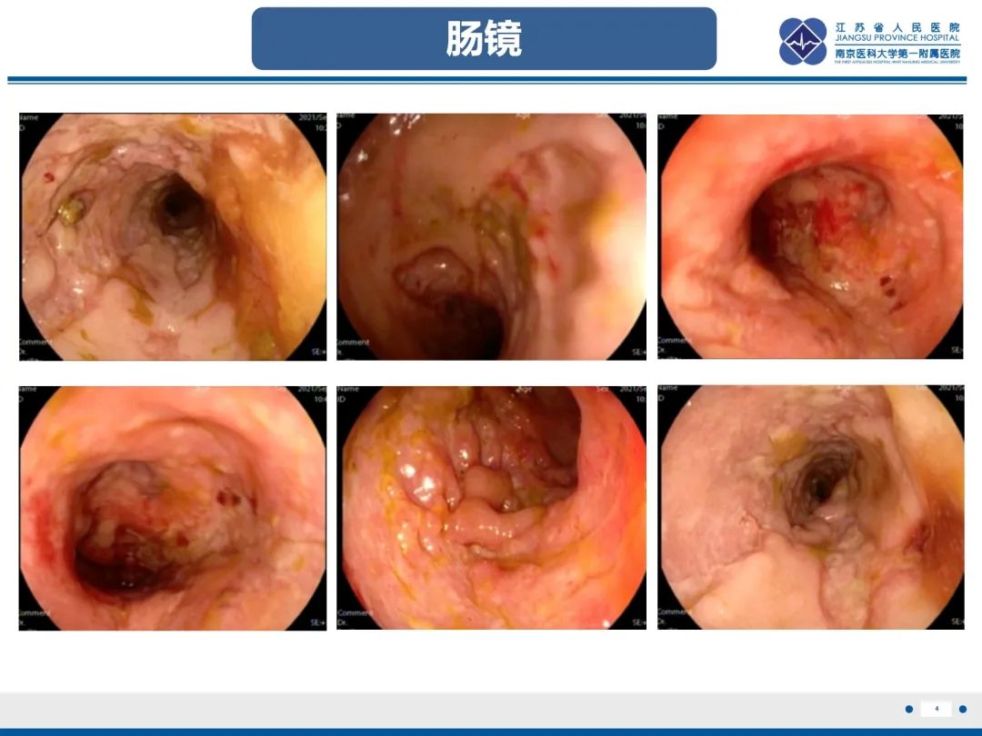 影像PPT - 【PPT】巨细胞病毒性肠炎-5