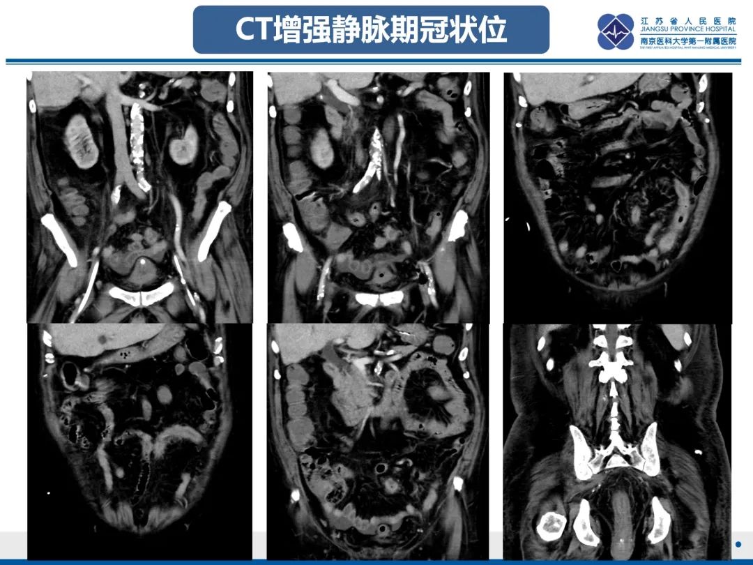 影像PPT - 【PPT】巨细胞病毒性肠炎-4