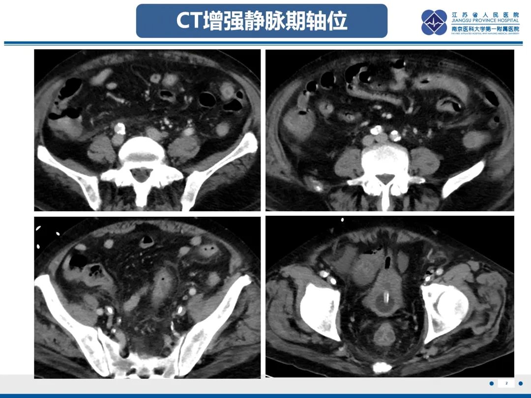 影像PPT - 【PPT】巨细胞病毒性肠炎-3