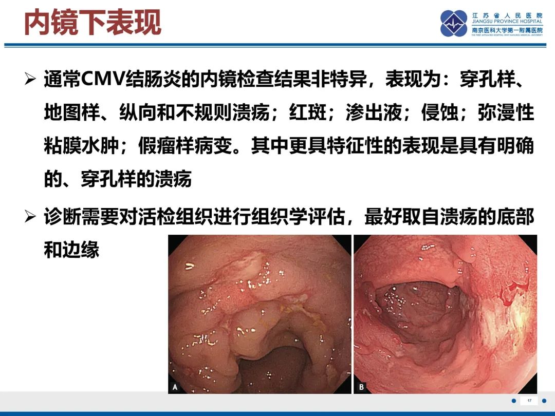 影像PPT - 【PPT】巨细胞病毒性肠炎-18
