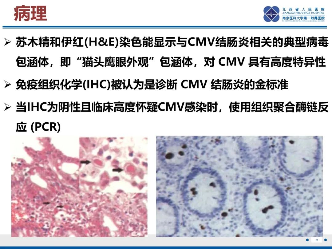 影像PPT - 【PPT】巨细胞病毒性肠炎-19
