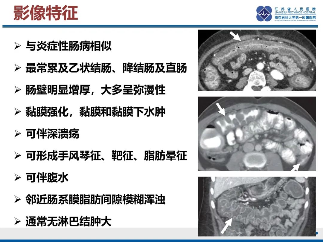 影像PPT - 【PPT】巨细胞病毒性肠炎-20