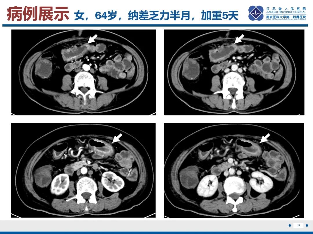 影像PPT - 【PPT】巨细胞病毒性肠炎-26