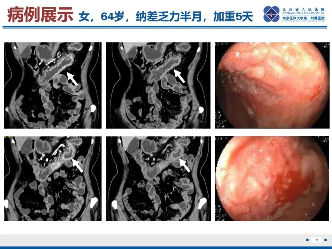 影像PPT - 【PPT】巨细胞病毒性肠炎-27