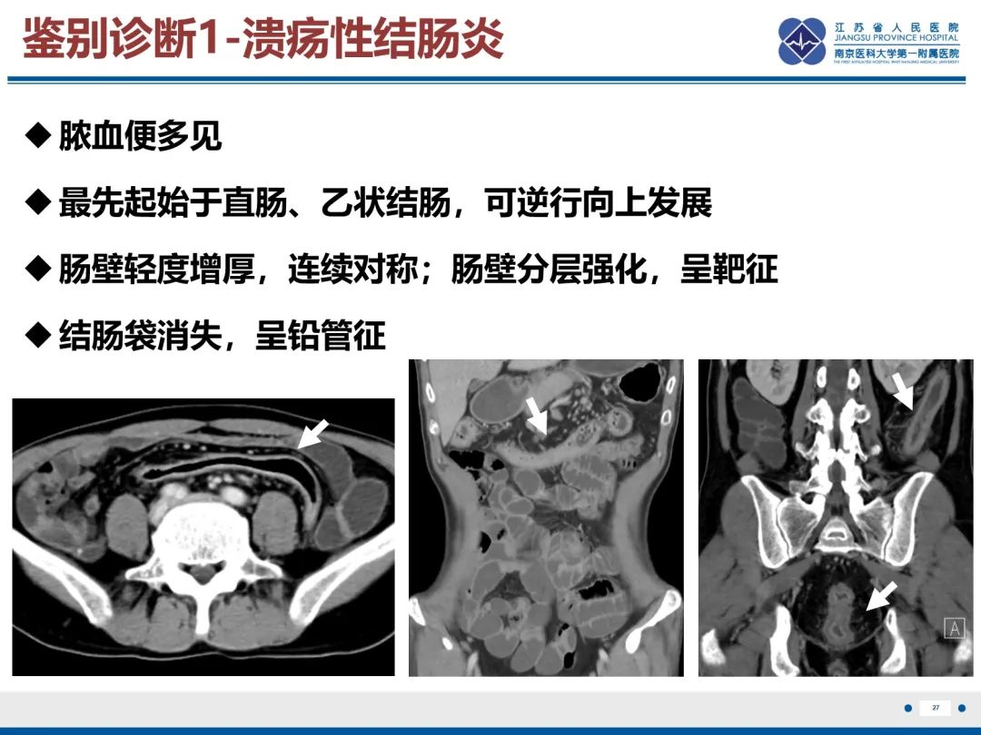 影像PPT - 【PPT】巨细胞病毒性肠炎-28