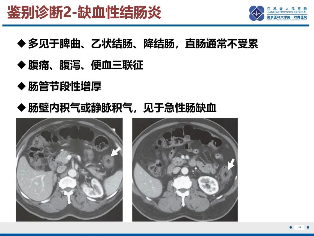 影像PPT - 【PPT】巨细胞病毒性肠炎-29