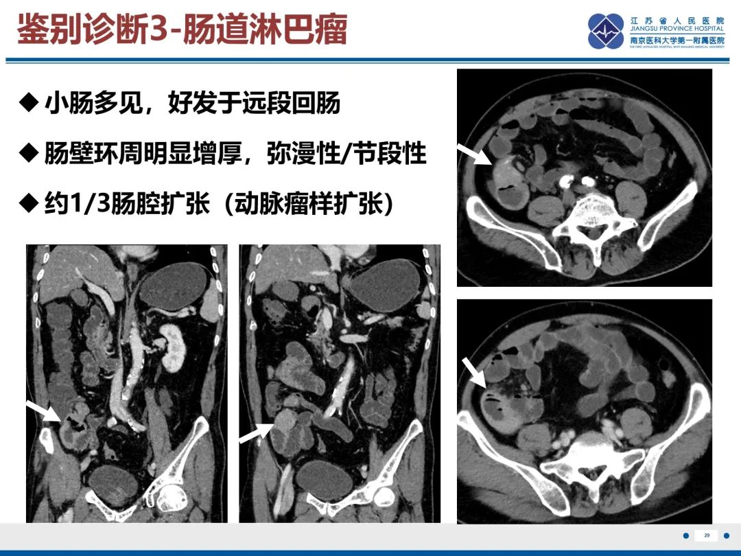 影像PPT - 【PPT】巨细胞病毒性肠炎-30