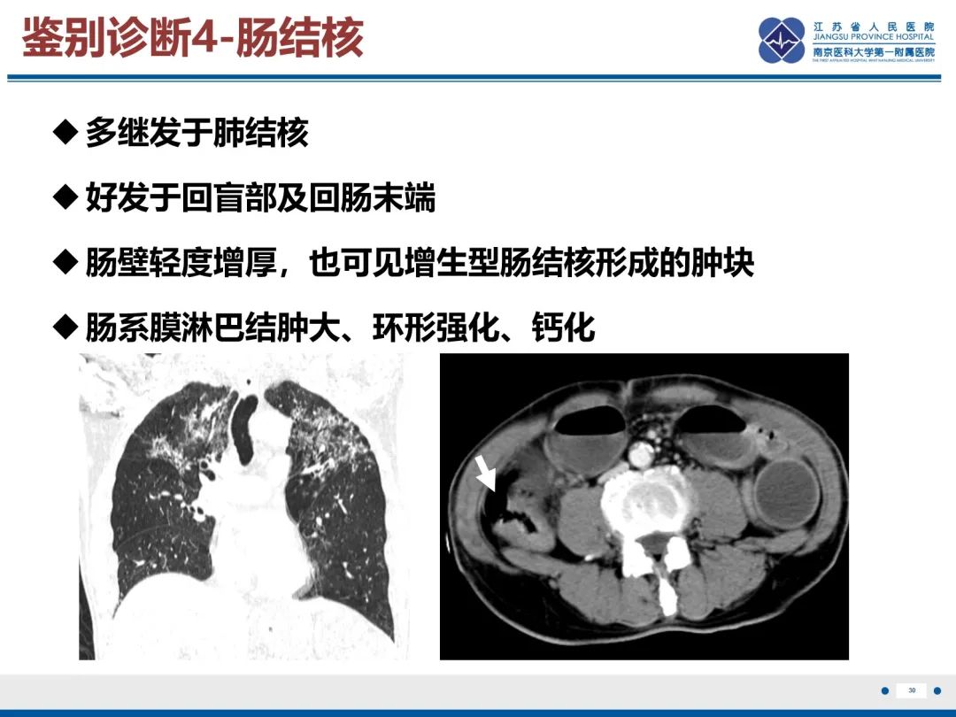 影像PPT - 【PPT】巨细胞病毒性肠炎-31