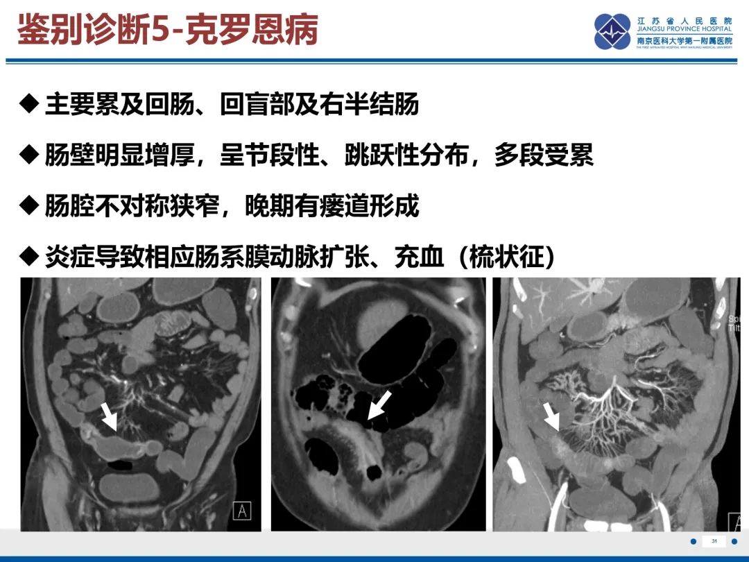 影像PPT - 【PPT】巨细胞病毒性肠炎-32