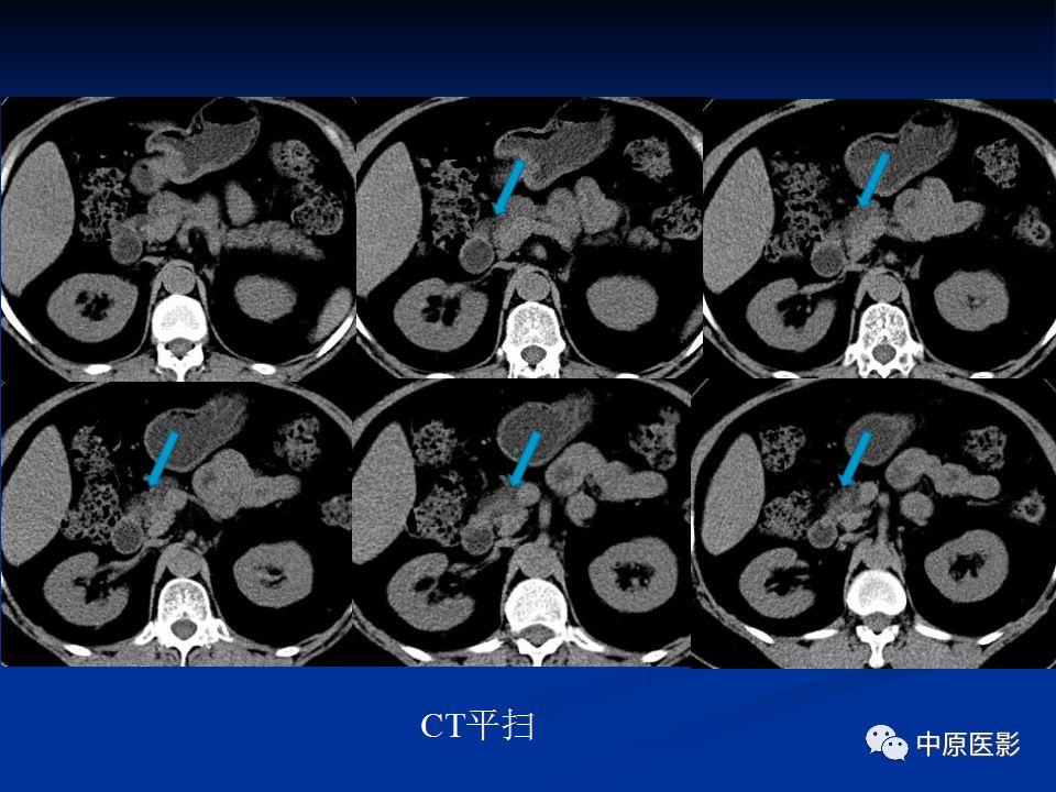 影像PPT - 【病例】胰腺局灶性脂肪浸润1例CT及MR-3