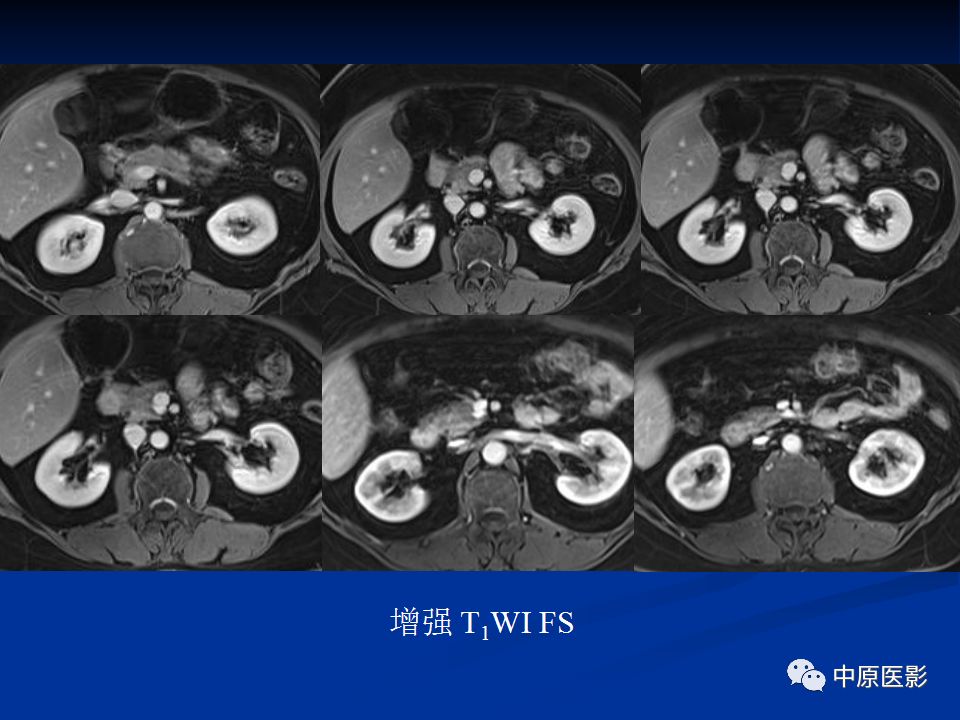 影像PPT - 【病例】胰腺局灶性脂肪浸润1例CT及MR-9