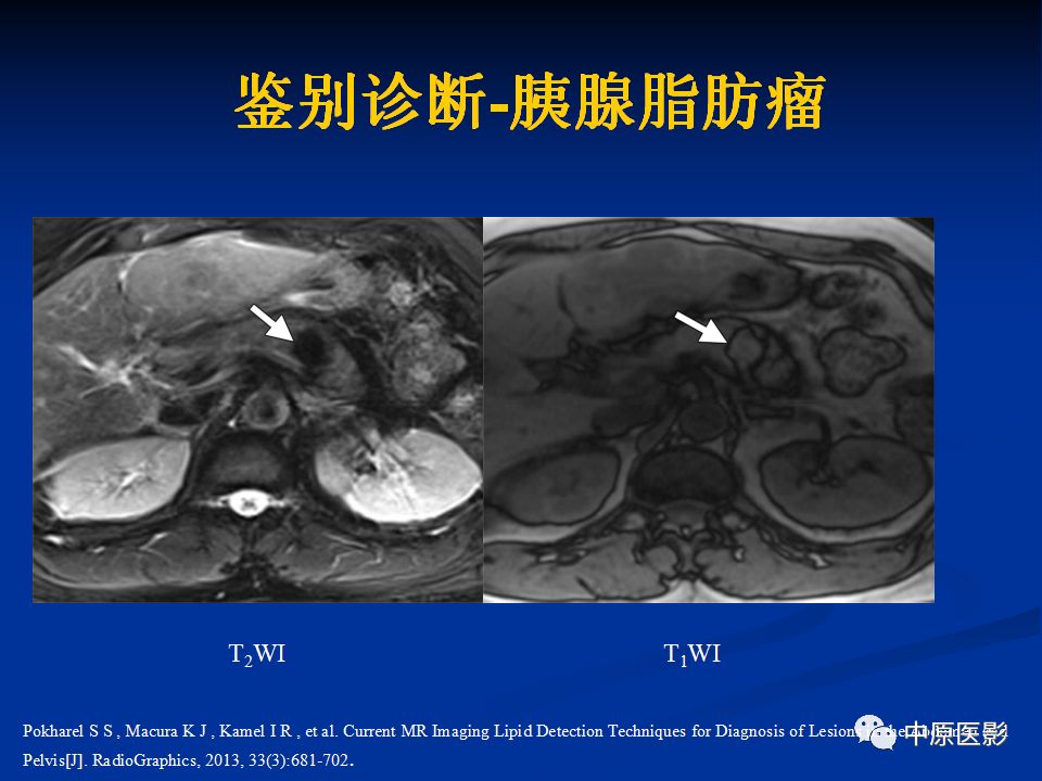 影像PPT - 【病例】胰腺局灶性脂肪浸润1例CT及MR-17