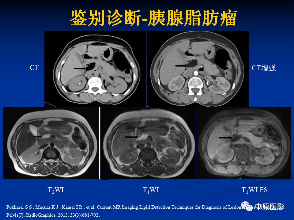 影像PPT - 【病例】胰腺局灶性脂肪浸润1例CT及MR-18